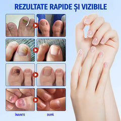 【Set 5 Pachete (Total 105 Plasturi)】Plasturi Tratament pentru Ciuperca Unghiei – Combate Infecțiile Bacteriene, Reface Structura și Culoarea Unghiilor de la Mâini și Picioare